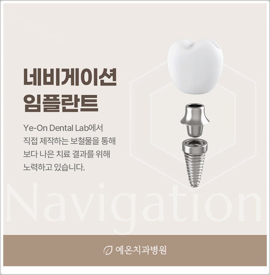 임플란트 픽스처·지대주·크라운 구조 일러스트와 함께 “네비게이션 임플란트”, 원내 기공소 Ye-On Dental Lab에서 보철물을 직접 제작한다는 설명이 적힌 예온치과병원 안내 이미지